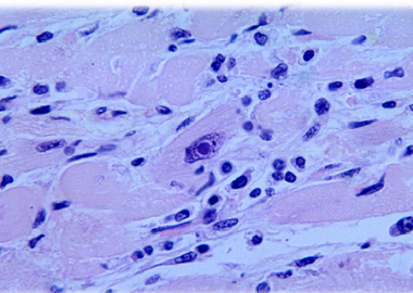 Noticias | Perú tiene el primer caso de difteria, luego de 20 años sin la peligrosa bacteria