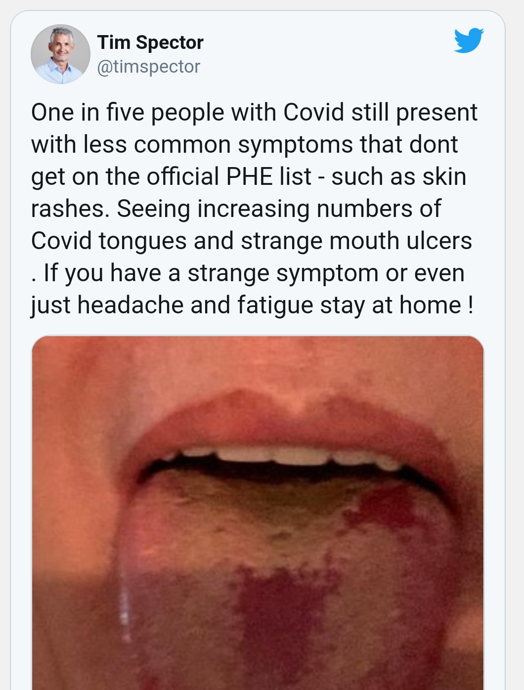 Noticias Chile | Detectan nuevo síntoma del covid-19 que aparece en la lengua de los enfermos 